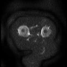 dwi_b1000_mca.gif
