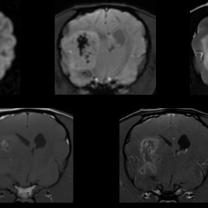 braintumorallseq.png