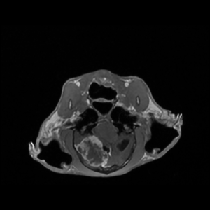 ax_fspgr_meningioma_hyperostosis91.png