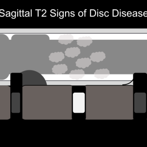 sagt2signsofivddnolabels.png