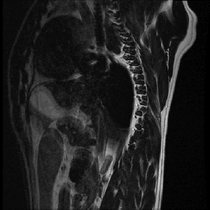 sag_t2_arachnoid_web.gif
