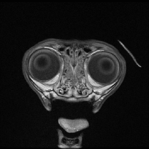 ax_t1_c_meningioma.gif