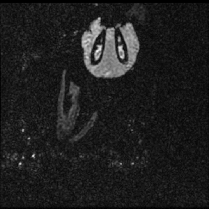 copy_of_double_meningioma.gif