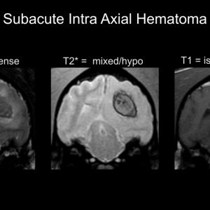 subacutehematoma.png