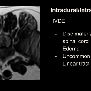 intraduralintramedullarydiscslide.png