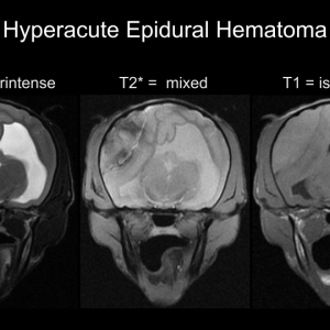 hyperacutehematoma.png