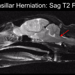 brainherniate.png