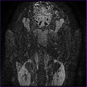 opticnervedorsaloblique.gif