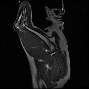 sag_t2_bp_1_.gif