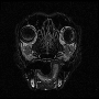 flair_cancer_ventricle.gif