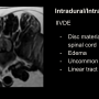 intraduralintramedullarydiscslide.png