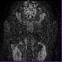 opticnervedorsaloblique.gif