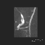 dwi_bp_mip_1_.gif