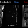 arachnoiddiverticulumslide.png