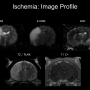 ischemia_profile.png