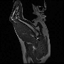 sag_t2_bp_1_.gif