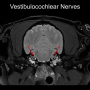 vestibulocochlearnervesslide.png