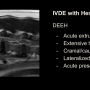 ivdhemoslide.png