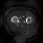dwi_b1000_mca.gif