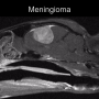 meningiomalabel.png