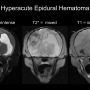 hyperacutehematoma.png