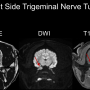 trigemtumorlabeled.png