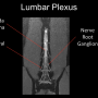 lumbarplexusanatomyslide.png