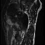 sag_t2_arachnoid_web.gif