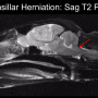 brainherniate.png