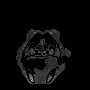 fspgr_cancer_ventricle.gif