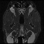 dor_t2_flair_fs_optic_nerve.gif